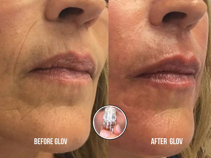 Glov Micro Infusion System