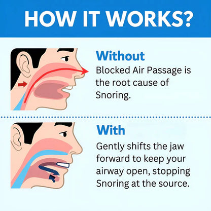 Anti Snore Mouth Guard